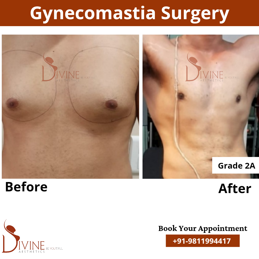 gynecomastia surgery in delhi