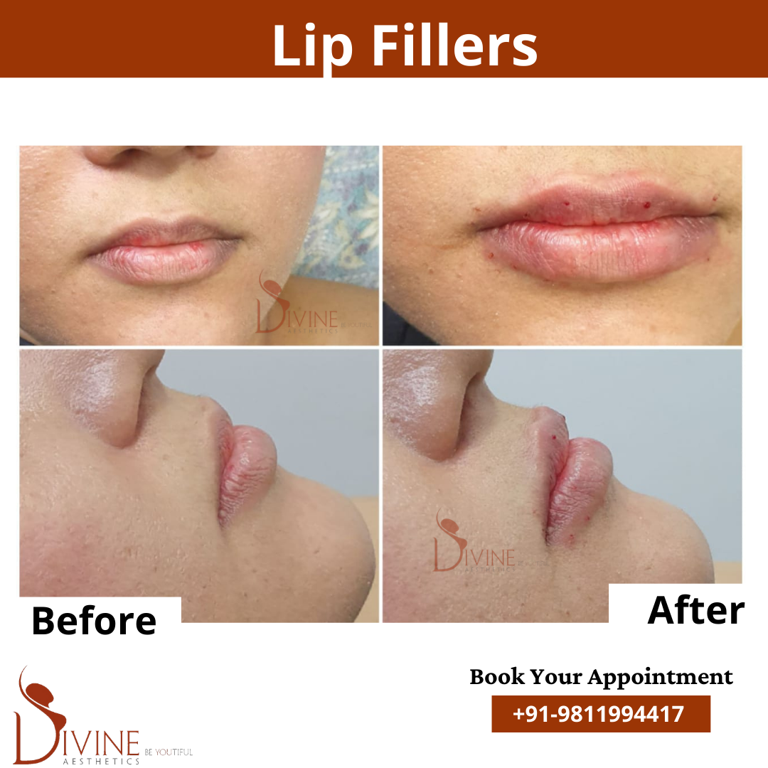 lip implant before after