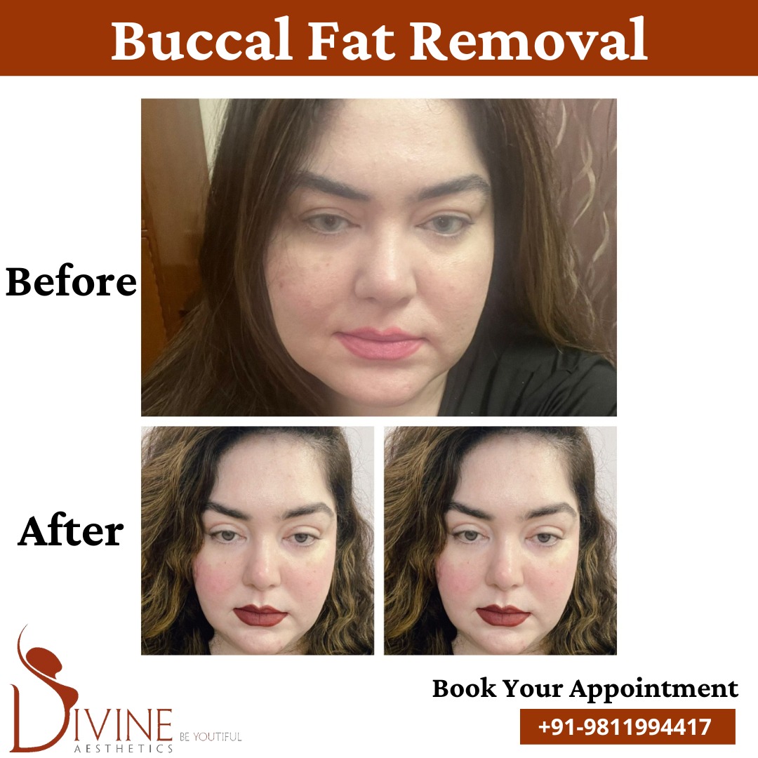 A women in Black Cloth Buccal Fat Result