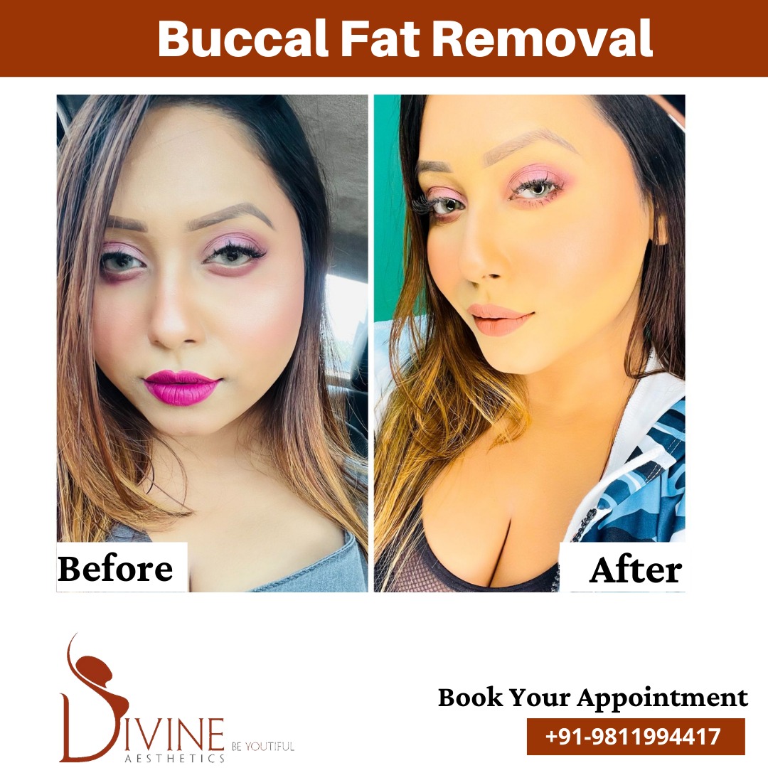 Buccal fat girl before and after result