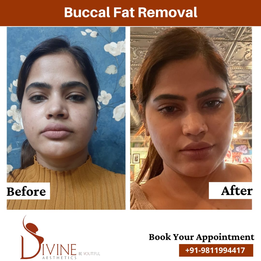 Buccal Fat removal girl in yellow top