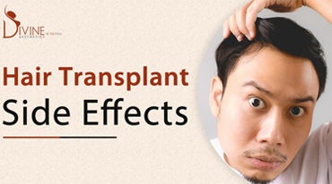 side effects of hair transplant