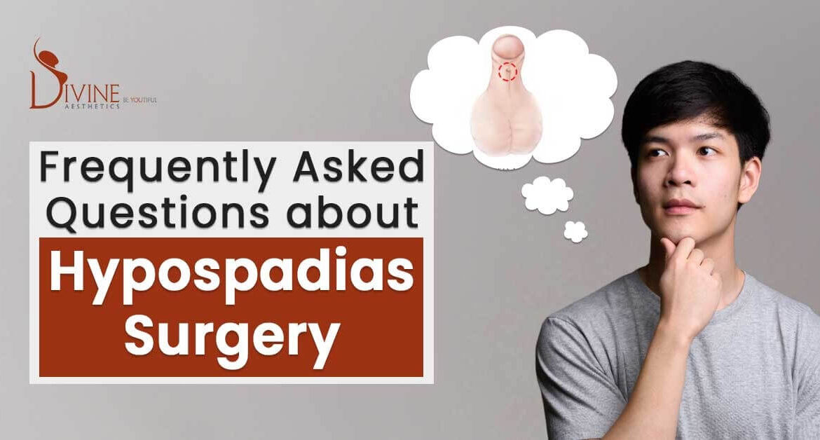 FAQs on Hypospadias Surgery