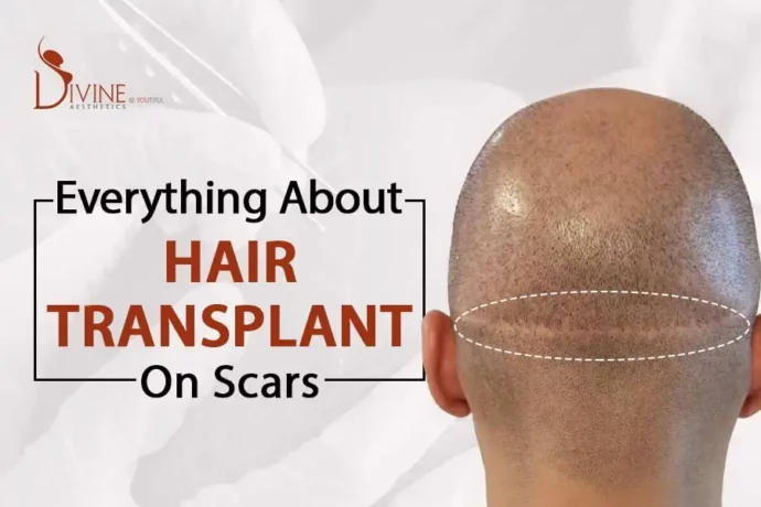 FUT Hair Transplant Scars