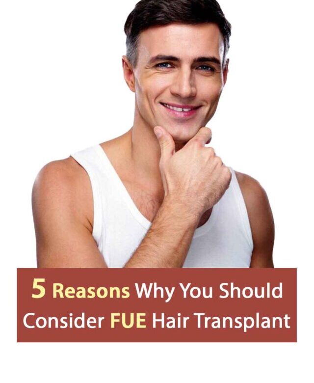5 Reasons Why You Should Consider FUE Hair Transplant