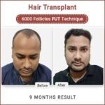 Benefits of Fut hair transplant in Delhi