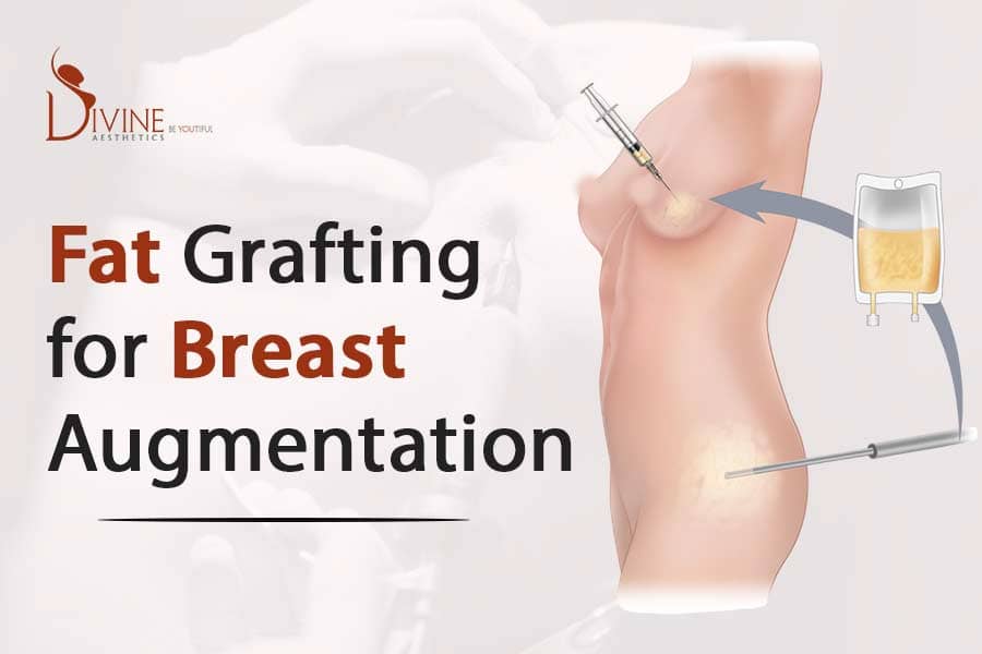 Fat Grafting for Breast Augmentation – Procedure, Results, Benefits