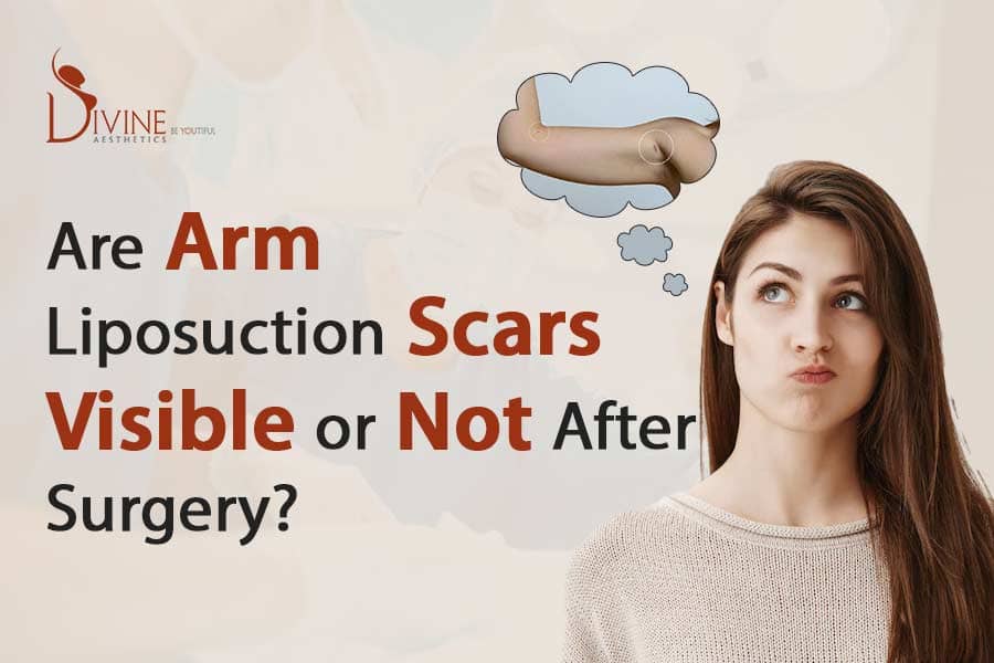 Are Arm Liposuction Scars Visible or Not After Surgery?