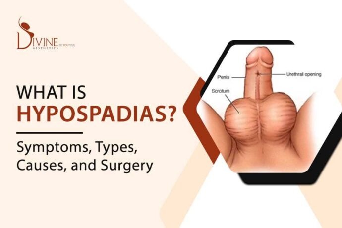 What is Hypospadias? Its Symptoms, Types, Causes, and Solution image