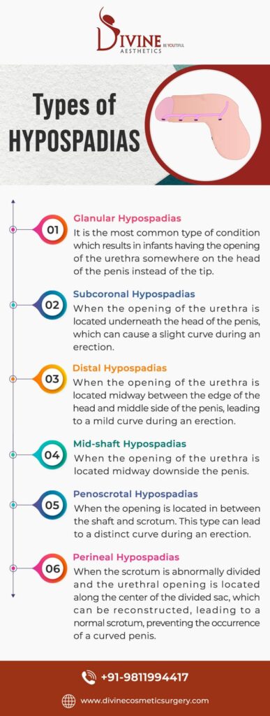 Types of hypospadias surgery