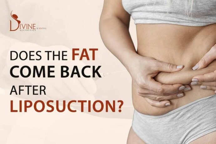 Does the Fat Come Back After Liposuction banner