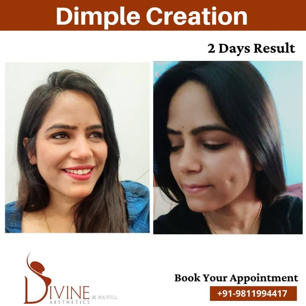 Dimple surgery before and after