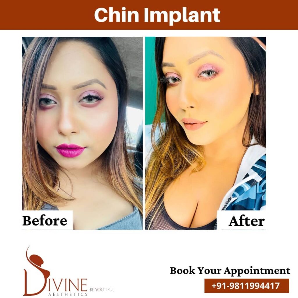 Chin Implant Before After