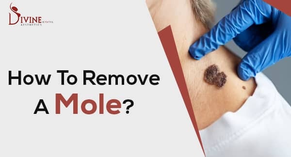 How To Remove A Mole? Mole Removal Surgery In Delhi