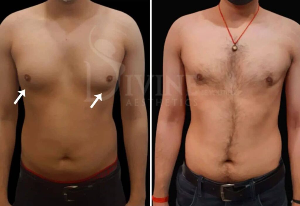 Gynecomastia surgery before and after -result images