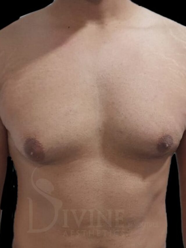Why some gynecomastia patients are unhappy with their results