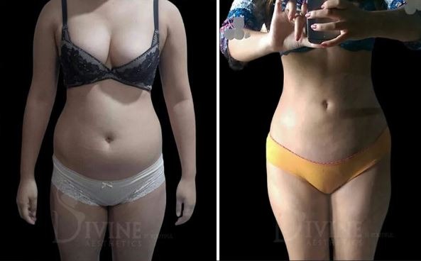 Liposuction Before After Image