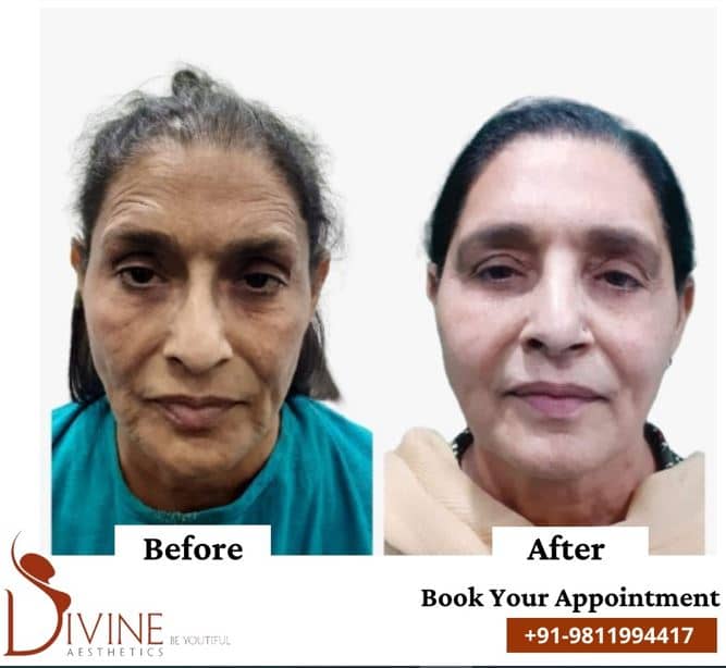 wrinkles treatment result