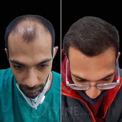 hair transplant doctor/surgeon result in delhi