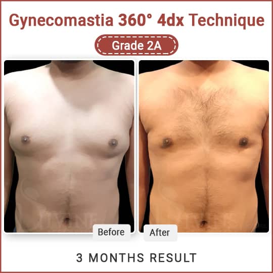 Best Result of Gynecomastia Surgery