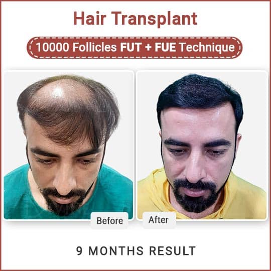 Best hair transplant result