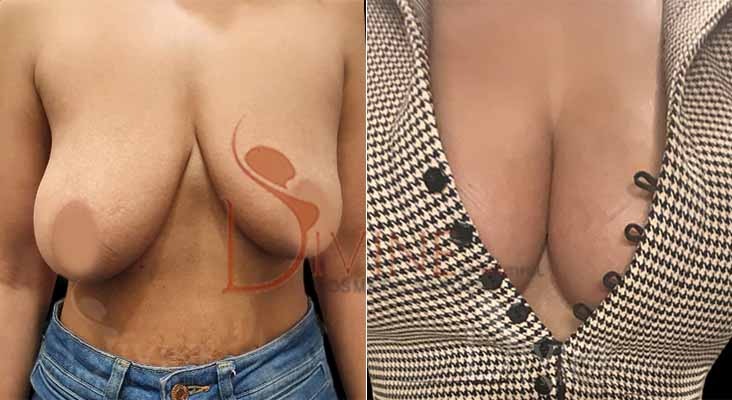 Breast Lift Before After Results