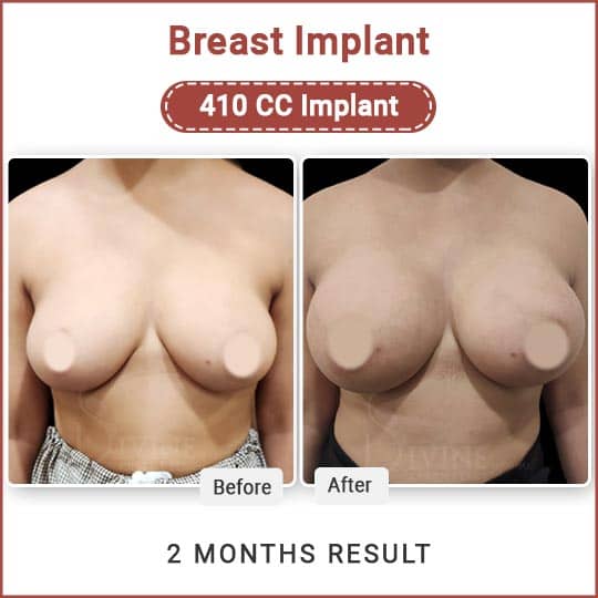 Breast augmentation surgery result