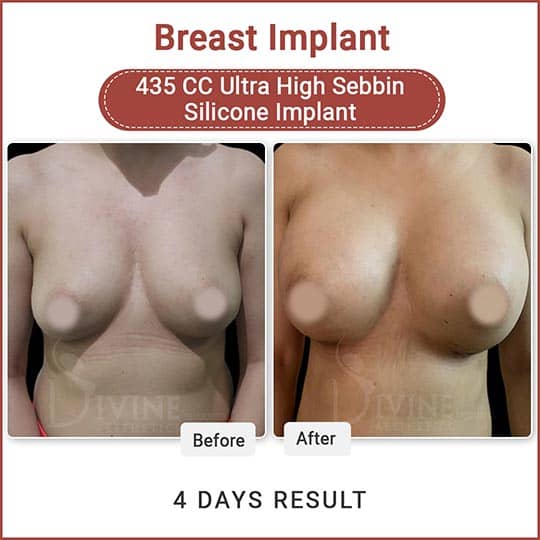 Breast implant before after