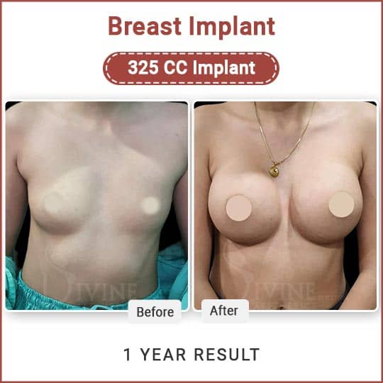 Breast implant before after