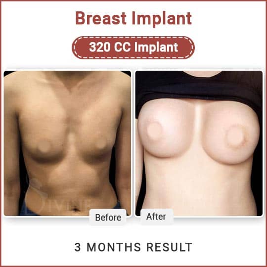 Breast implant surgery result