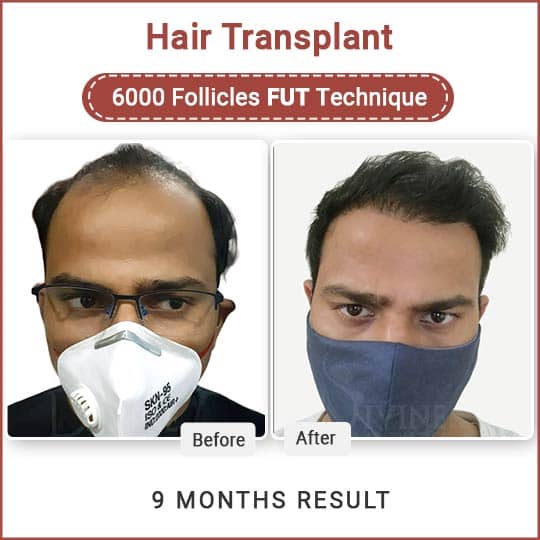 FUT Hair Transplant Before After