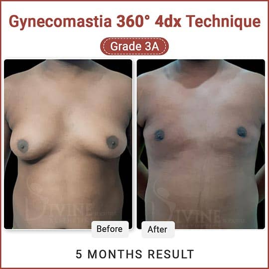 Gynecomastia 360 degree surgery result
