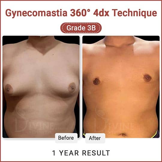 Gynecomastia 360 degree surgery before after