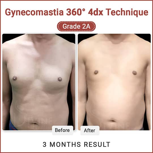 Gynecomastia before after result