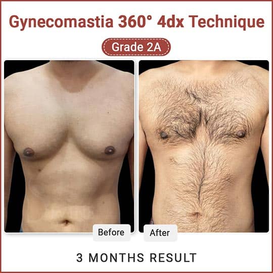 Gynecomastia before and after