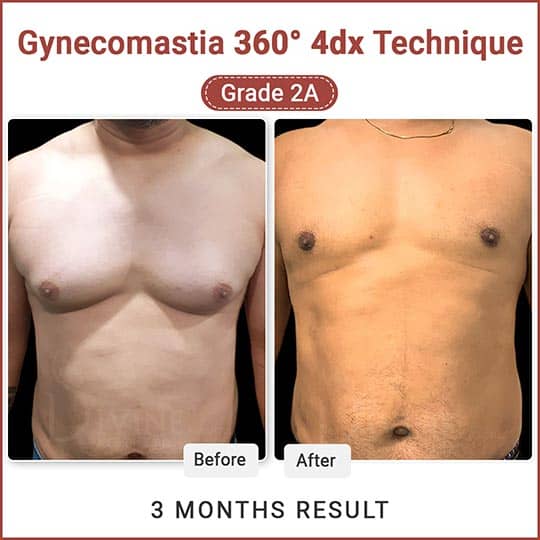 Gynecomastia before after result
