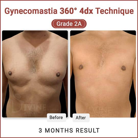 Gynecomastia before after surgery