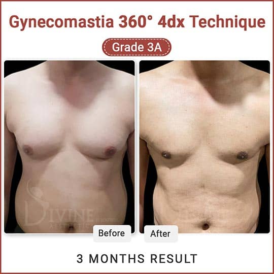 male breast reduction result