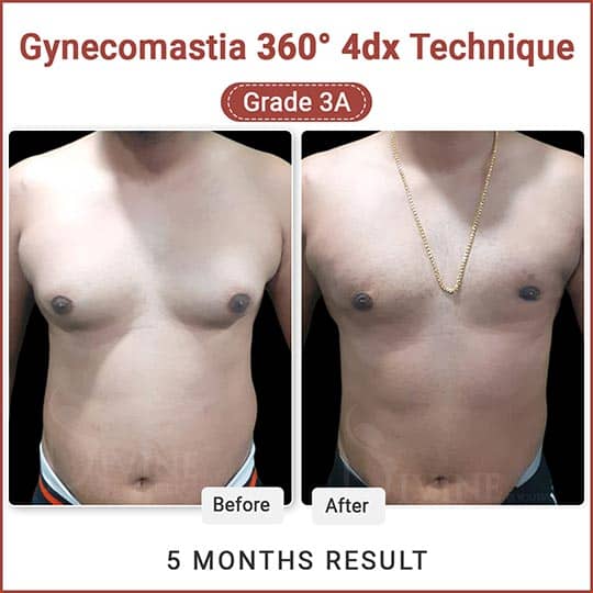 Gynecomastia surgery result