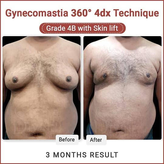 Gynecomastia surgery grade 4b result
