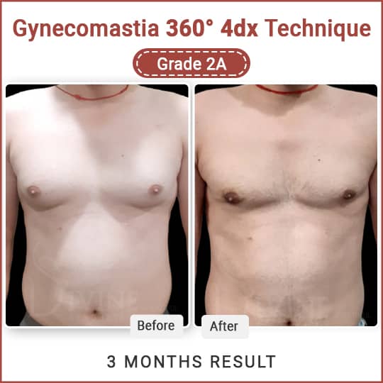gyno surgery result
