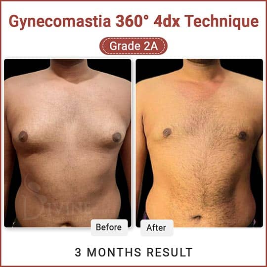 Gyno before after