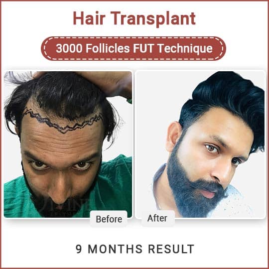 Best Hair Transplant center in India