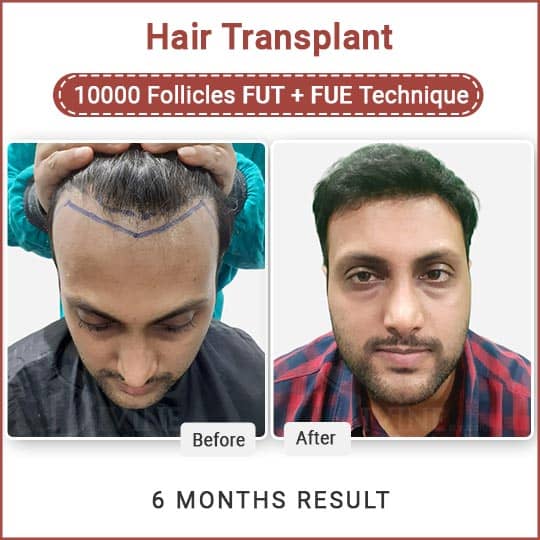 hair transplant combination technique surgery