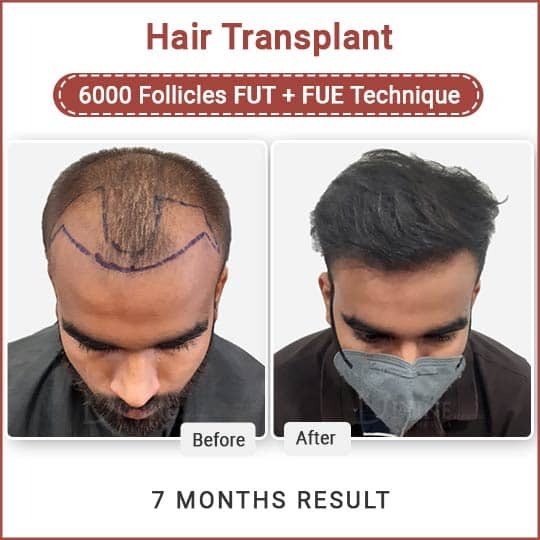 hair transplant combination technique result