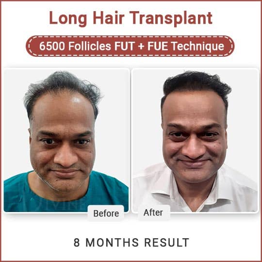 Long Hair transplant before after photo