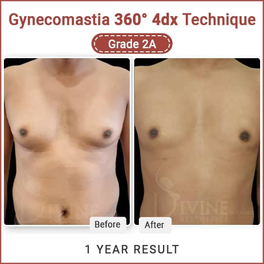 Male Breast Reduction Surgery Result