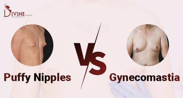 Puffy Nipples or Gyno