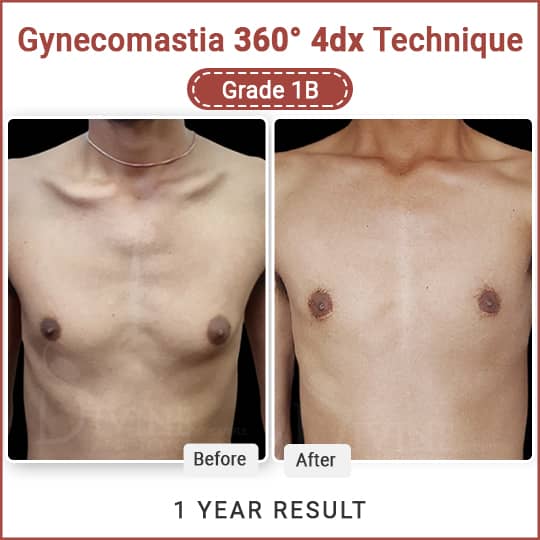 gynecomastia puffy nipple surgery result