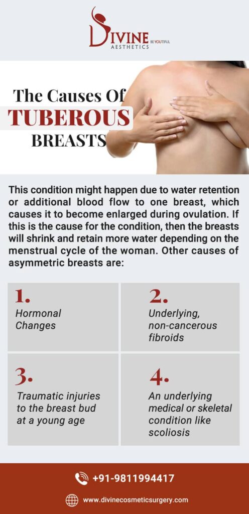 The Cause Of Tuberous Breasts